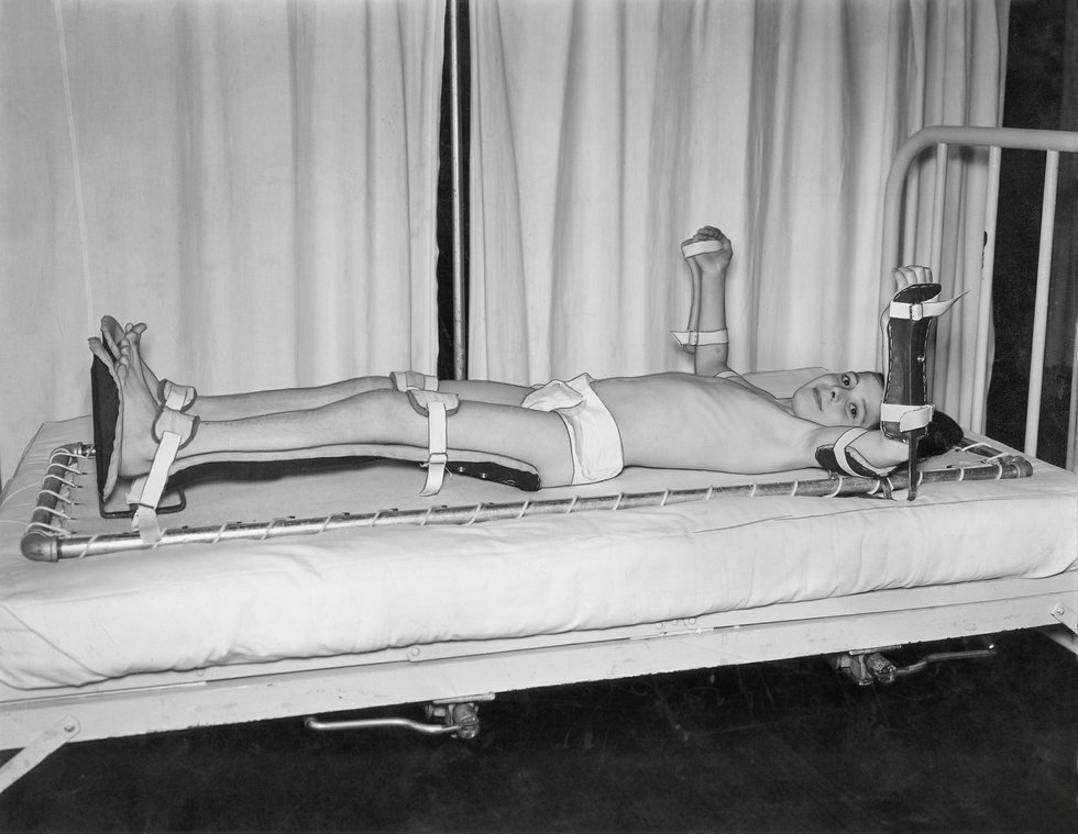 Polio, boy in Bradford frame - 1937 - AR.JPG